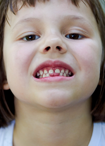 shutterstock 35113066 kiz cocuk dis otistik otizm glr